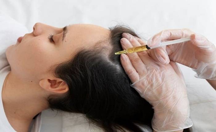 PRP Therapy Explained: A Natural Hair Loss Solution PRP Therapy